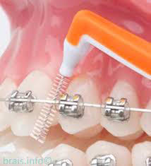 Cómo cuidar tus dientes si llevas ortodoncia