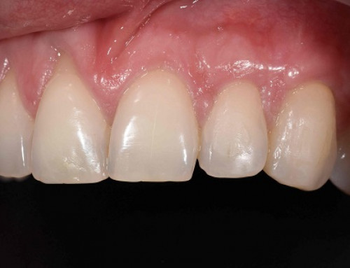 Causas de la retracción gingival y soluciones