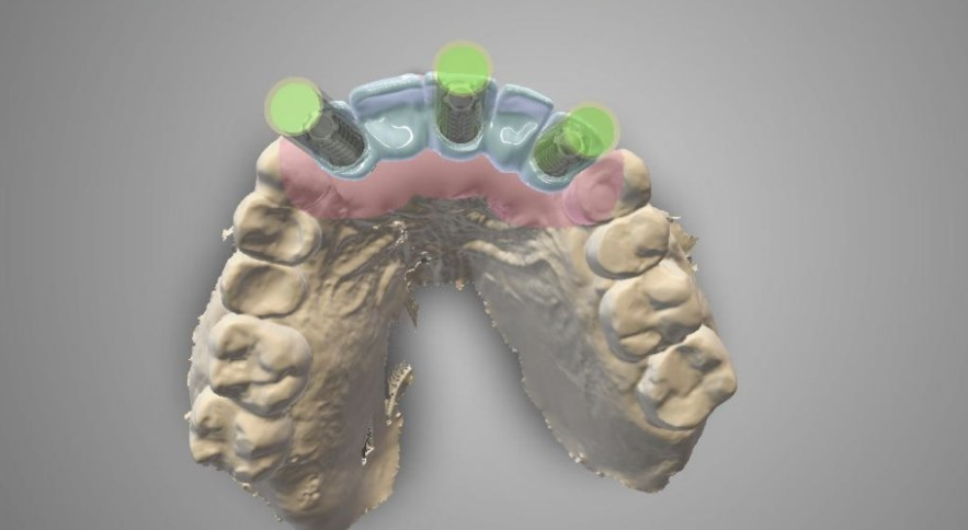campaña implantes dentales