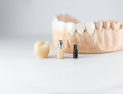 Cirugía guiada de implantes dentales: paso a paso de la técnica