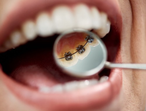 Brackets linguales: ventajas y características