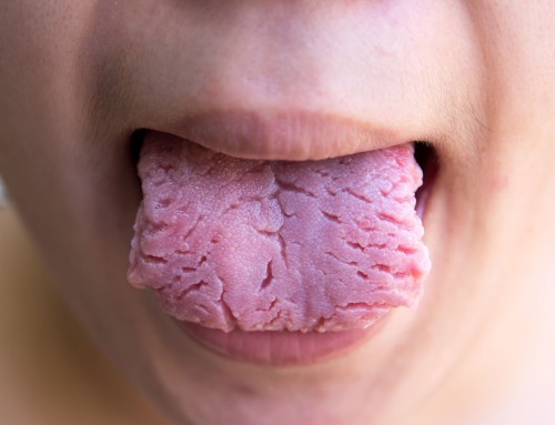 La Lengua Geográfica: Causas, Síntomas y Cómo Afecta a la Salud Bucal