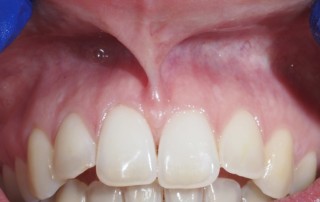 Frenectomía Dental