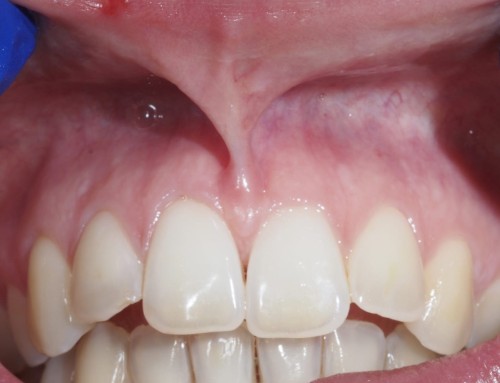 Frenectomía Dental con Láser en Leganés: Precisión, Recuperación Rápida y Resultados Estéticos
