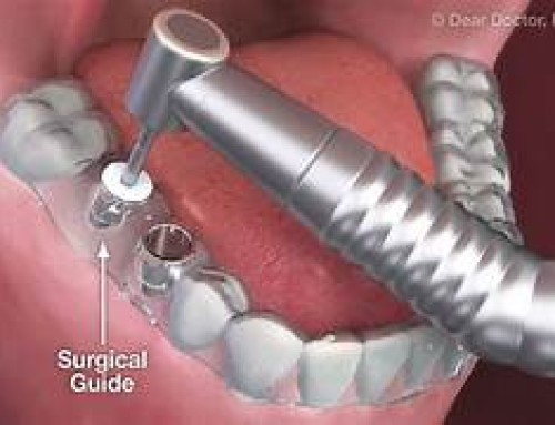 Implantes dentales de alta precisión en LEGANÉS