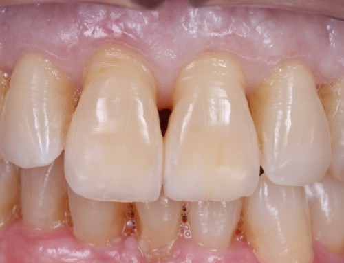 Injertos de encías: todo lo que debes saber