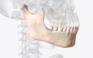 Perdida de hueso dental
