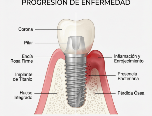 Periimplantitis: la infección silenciosa que puede poner en riesgo un implante (síntomas, tratamientos y prevención)