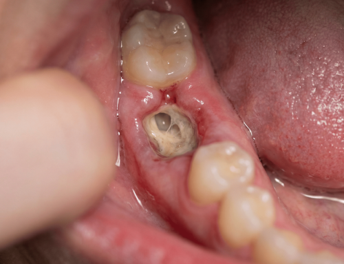 Alveolitis Seca: ¿Por Qué Duele Tanto Después de una Extracción Dental y Cómo Se Trata de Verdad?