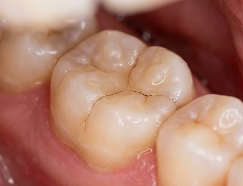 Síndrome del Diente Fisurado: ¿Por Qué Duele al Morder y Cómo se Diagnostica a Tiempo?
