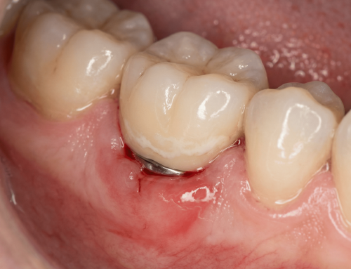 Periimplantitis: ¿Por Qué se Inflama un Implante Dental y Cómo Evitar Perderlo?