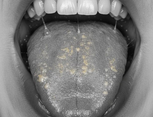 Halitosis persistente: cuando el mal aliento no se va aunque te cepilles bien