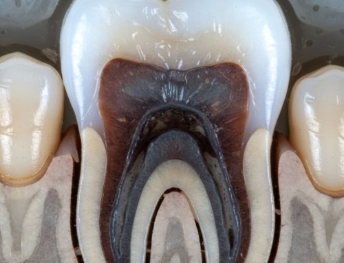 ¿Por qué se oscurece un diente sin caries?